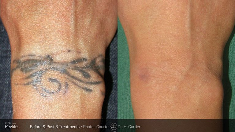 PERMANENT TATTOO REMOVAL BY LASER - YouTube